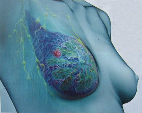王慧:破解乳腺癌患病风险